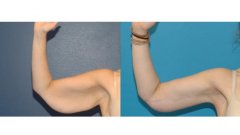 胳膊有蝴蝶袖怎么消除(怎样消除胳膊上的蝴蝶袖)