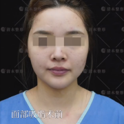面部吸脂整形修复多少钱(面部吸脂大概要多少钱)