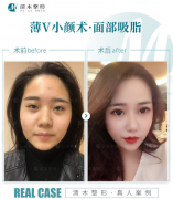 脸部吸脂瘦脸多少钱(脸部吸脂多少钱?)