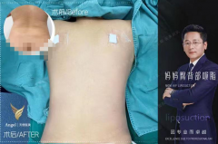 吸脂术后修复多少钱(抽脂修复手术多少钱)