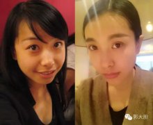 上眼皮吸脂要多少钱(眼部吸脂大概多少钱)