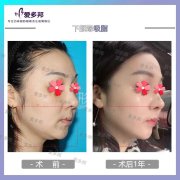 面下颌缘吸脂多少钱(下颌缘抽脂多少钱)