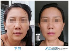 吸脂手术多少钱啊(全身吸脂多少钱)